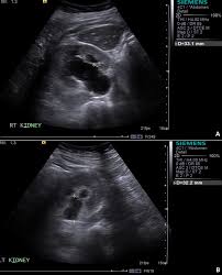 Hypertension, proteinuria, renal damage and even chronic renal failure, which requires dialysis treatment in a significant number of adults. Ultrasound Of Renal Tract A Right Renal Pelvis Measuring 33mm In Ap Download Scientific Diagram