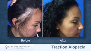 The bald area progressively recedes farther and farther back, forming a band around the top and side edges that resembles a receding hairline. Balding Edges Traction Alopecia Is Treatable Hair Restoration Center Of Ct Fue Hair Transplant