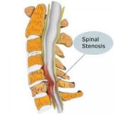 Spinal Stenosis All You Need To Know Runnerclick In 2020 Spinal Stenosis Lumbar Spinal Stenosis Stenosis