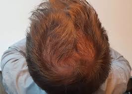 Wollen sie sehen frisuren für dünne wenige haare. Haarwuchsmittel Im Selbsttest Erfolgreich Haarausfall Stoppen