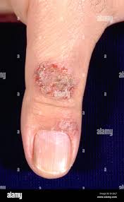Image result for Eczema nummulare