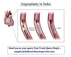 Angioplasty Surgery Cost In India Surgery Best Hospitals Cardiology