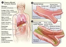 Thick mucus can block the tubes that carry digestive enzymes from your pancreas to your intestines. Cystic Fibrosis Wikipedia
