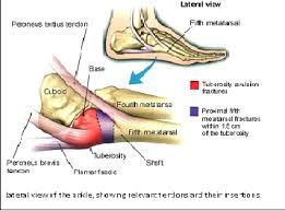 Digital pressure of sciatic notch. Avulsion Fractures Of The Ankle Physiopedia