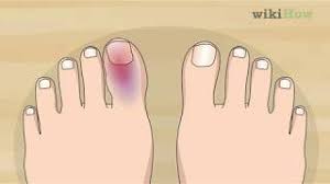 Fractured broken big toe pictures. How To Know If Your Toe Is Broken Advice From A Foot Surgeon