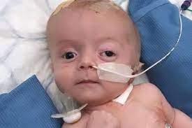 Restricted treatments and for the treatment of obstructive sleep apnoea. Four Week Old Baby S Feeding Problems Were Signs Of Huge Brain Tumour Mirror Online