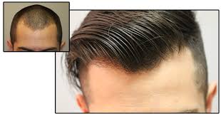 Tj hair clinic is the only mexican hair transplant clinic to be bbb certified in mexico, specializing in fue hair transplant medical hair restoration technique at affordable low prices without sacrificing quality. Dr Troy Fallon Hair Transplant Surgeon Portland Or Fue And Fut Hair Restoration
