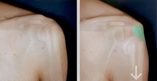 Image result for Shoulder Instability Exam