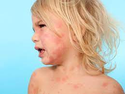 Pet Allergies Ages 2 To 4 Babycenter