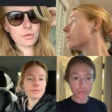routine help] Post Accutane Maintenance of Clear Skin... Explanation in  Comments : r/SkincareAddiction