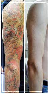 The laser actually shatters the ink that is embedded in the skin into fragments. Picosecond Lasers Meeting Advanced Tattoo Removal And Changing Demographics Needs Modern Aesthetics