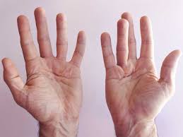 Vous avez mal aux pieds? Perte De Poigne Le Syndrome De La Main Diabetique Diabetes Voice