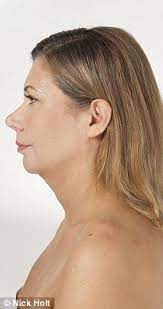 The One Stitch Facelift Claims To Be The Ultimate Quick Fix For Turkey Necks But Does It Work One Stitch Facelift Turkey Neck Facelift