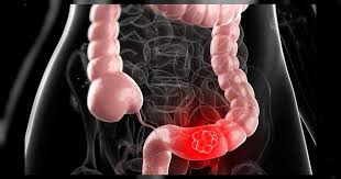 El colon irritable, cuya denominación más exacta es síndrome del intestino irritable (sii), se engloba dentro de. Complicatiile Sindromului De Colon Iritabil