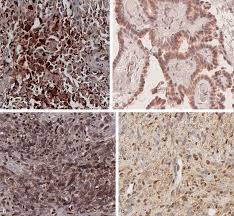 2 cancer risks you have an increased chance to develop mesothelioma, kidney (renal) cancer, melanoma (skin cancer), uveal (eye) melanoma, and other tumor types. Mesothelioma Families Without Inheritance Of A Bap1 Predisposing Mutation Sciencedirect