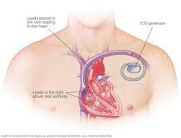 Die deutsche stabhochspringerin katharina bauer betreibt damit etwa. Implantable Cardioverter Defibrillators Icds Mayo Clinic