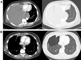 Check spelling or type a new query. Air In The Pleural Cavity Enhances Detection Of Pleural Abnormalities By Ct Scan Chest