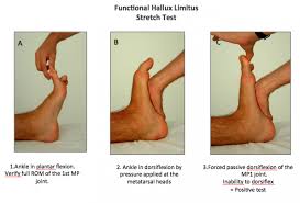 Stiff Big Toe Hallux Rigidus Hallux Dry Needling Inflammatory Arthritis