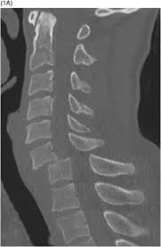 Lumbar interlaminar epidural injections are commonly performed for a variety of spinal pain disorders. Bilateral Facet Dislocation Case 30 Clinical Imaging Of Spinal Trauma
