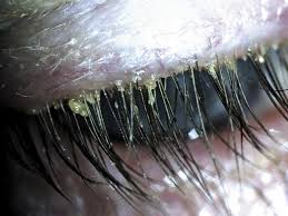 Image result for Demodex folliculorum