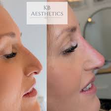 Real tears in clinic for this rhinoplasty Such a beautiful change, but  staying with a natural appearance 3 point rhinoplasty is the safest most  advanced technique. Please message for info or to
