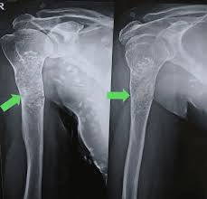 Image result for Chondrosarcoma
