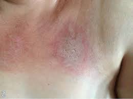 The signs of breast cancer can be subtle and identifying them early on can help your prognosis. A Rare Case Of Severe Myositis As Paraneoplastic Syndrome On Breast Cancer World Journal Of Surgical Oncology Full Text