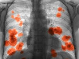 Of course, your specialist is the main person whose advice you should follow but it doesn't do anyone harm. A Closer Look At The Top 5 Deadliest Cancers
