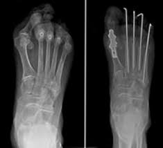 Image result for XRay Changes in Rheumatic Conditions