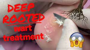 It is unimaginable how irritating and painful these warts can get. Deep Rooted Wart Treatment Youtube