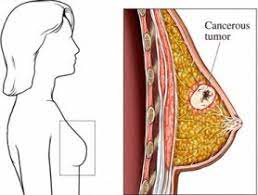 If you have a personal or family history of breast cancer, you need to talk to your doctor to find out how high your risk really is. Breast Cancer Information Every Woman Must Know Health News