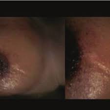 Mondor's disease (also known as mondor's syndrome of superficial thrombophlebitis2) is a rare condition which involves thrombophlebitis of the superficial veins of the breast and anterior chest wall. Pdf Mondor S Disease Classical Imaging Findings In The Breast