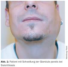 Image result for Sialolithiasis