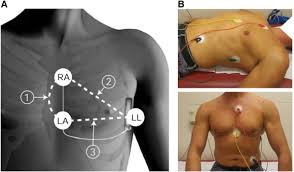 A biventricular pacemaker and icd is a small, lightweight device powered by batteries. Evaluation Of A Novel Automatic Screening Tool For Determining Eligibility For A Subcutaneous Implantable Cardioverter Defibrillator International Journal Of Cardiology