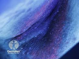 Image result for Erythrasma