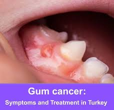 Image result for dental cancer