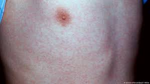 In a recent interview, dr. 5 Sintomas Do Coronavirus Na Pele Agir Brasil Saiba O Que Fazer Nesta Quarentena Para Nao Pegar O Coronavirus