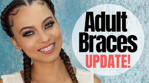 VLOG: I GOT BRACES! COST + MY DENTAL ISSUES + INSECURITIES!