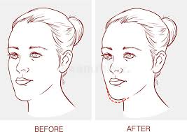 Orthognathic (corrective jaw) surgery in provo ut: Oral Surgery Stock Illustrations 5 336 Oral Surgery Stock Illustrations Vectors Clipart Dreamstime