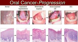 Individuals who smoke or consume large amounts of alcohol are at an increased risk and need to be screened regularly. The Warning Signs Symptoms Of Mouth Cancer Emergency Dentist Brooklyn Ny