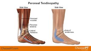 The ankle, or the talocrural region, is the region where the foot and the leg meet. Physical Therapy Guide To Peroneal Tendinopathy Choosept Com