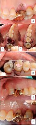 Both tooth decay and an injury can cause a dead tooth. Tooth Transplant Wikipedia