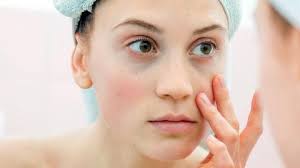 Cara hilangkan dark circle, mata panda dan wrinkles. Ketahui Jenis Jenis Dark Circle Dan Cara Menghilangkannya