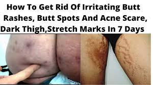 When your doctor turns attention to the scars your acne has left behind, they will typically explore three main treatment options: How To Get Rid Of Butt Acne Fast How To Remove Dark Spots Pimples Acne Scars Clear Dark Thigh Youtube