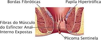 Fissura Anal Dr Derival Santos Coloproctologia E Colonoscopia