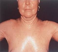 Maybe you would like to learn more about one of these? Esclerosis Sistemica Trastornos De Los Huesos Articulaciones Y Musculos Manual Msd Version Para Publico General