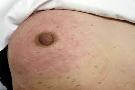 Image result for Inflammatory breast cancer