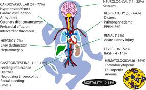 Image result for Multisystem Inflammatory Syndrome