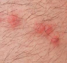 Their bites take the form of flat, red patches or raised, red bumps, and they sometimes might even become blisters or pustules. Identify Bug Bites Common Bug Bites Orkin