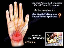 Patient Self Diagnose Carpal Tunnel Syndrome - Everything You Need To Know  - Dr. Nabil Ebraheim - Youtube